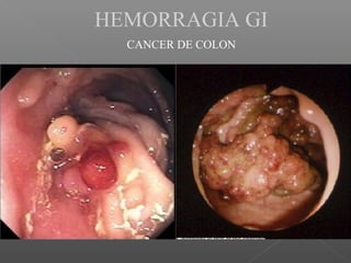 HEMORRAGIA GI
CANCER DE COLON
 