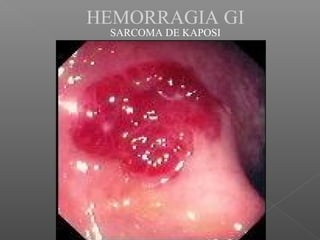 HEMORRAGIA GI
SARCOMA DE KAPOSI
 
