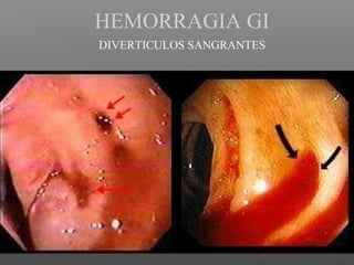 HEMORRAGIA GI
DIVERTICULOS SANGRANTES
 