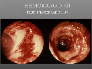 HEMORRAGIA GI
PROCTITIS POSTRADIACION
 