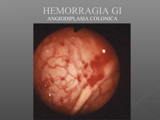 HEMORRAGIA GI
ANGIODIPLASIA COLONICA
 