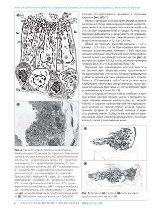 4 П ЛА С Т И ЧЕ СКАЯ ХИРУРГИЯ И КОСМЕТОЛОГИЯ
Женская предстательная железа. Современные возможности малоинвазивной коррекции сексуальных дисфункций
2013 (2) 193–368
плотную сеть рассеянного хроматина и отдельные
ядрышки (рис. 4) [17].
Область проекции женской простаты расположена
на передней стенке вагинального прохода на рассто-
янии около 5–6 (при заднем типе локализации) или
2–3 см (при переднем типе) от входа. Размер зоны
проекции варьируется в зависимости от индивиду-
альных особенностей, при стимуляции ее диаметр
может увеличиваться от 0,75 до 3,00 см.
Общий вес простаты взрослой женщины – 5,2 г,
размер – 3,3 x 1,9 x 1,0 см. При переднем типе лока-
лизации, встречающемся примерно у 70% взрослых
женщин, имеющих самое большое количество предста-
тельной ткани в дистальной половине уретры (рис. 5),
вес простаты равен 2,6–5,2 г, что составляет примерно
четверть веса (23,7 г) мужской простаты [18].
Передний тип локализации женской простаты
не соответствует общеизвестному топологическо-
му расположению «точки G», которое проецируется
в область задней уретры и шейки мочевого пузыря.
Только у 10% женщин в этой области располагается
наибольшее количество предстательной ткани (за-
дний тип женской простаты), и этот тип соответствуют
условному месту «точки G» [19].
Женская предстательная железа снабжается кро-
вью ветвей артерии прямой кишки и мочевого пу-
зыря: ветвями нижних мочепузырных (a. vesicalis
inferior) и средних прямокишечных (геморроидаль-
ных) артерий (a. rectalis media), а также предста-
тельной артерии (a. prostatica), которая отходит
от a. pudenda interim. В области железы все эти арте-
рии между собой широко анастомозируют. Венозная
кровь оттекает в одноименные вены.
Рис. 4. Схематическое строение секреторных
(люминальных), базальных (резервных) и двух типов
промежуточных клеток женской предстательной
железы: SC – секреторные клетки, SV – секретор-
ные вакуоли, SG – секреторные гранулы, P – апи-
кальный выступ цитоплазмы, MV – микроворсинки,
B – пузырек, RER – шероховатая эндоплазмати-
ческая сеть, V – пустые вакуоли, G – комплекс
Гольджи, NU – ядрышко, N – ядро, LD – липидная
мембрана, LY – лизосомы, BC – базальные клетки,
IC1 – промежуточные клетки I типа, IC2 – проме-
жуточные клетки II типа, BM – опорная мембрана,
ZO – зона окклюзии, ZA – зона адгезии, C – центри-
оль (а); нормальная женская предстательная желе-
за (б); электронная микроскопия, ув. х3000 [19]
Рис. 5. Предний (а) и задний (б) типы женской
предстательной железы [4]
а
а
б
б
 