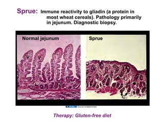 Sprue:   Immune reactivity to gliadin (a protein in
           most wheat cereals). Pathology primarily
           in jejunum. Diagnostic biopsy.


 Normal jejunum                    Sprue




                        Source Undetermined



              Therapy: Gluten-free diet
 