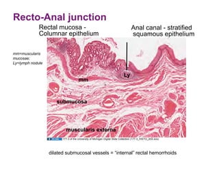 Recto-Anal junction
             Rectal mucosa -                                                      Anal canal - stratified
             Columnar epithelium                                                  squamous epithelium

mm=muscularis
mucosae;
Ly=lymph nodule


                                                                            Ly
                                     mm



                     submucosa




                          muscularis externa
                        177-3 of the University of Michigan Digital Slide Collection (177-3_HISTO_20X.svs).




                  dilated submucosal vessels = “internal” rectal hemorrhoids
 