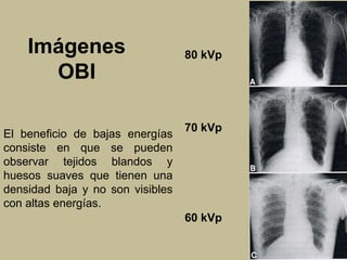 Imágenes 
OBI 
80 kVp 
70 kVp 
60 kVp 
El beneficio de bajas energías 
consiste en que se pueden 
observar tejidos blandos y 
huesos suaves que tienen una 
densidad baja y no son visibles 
con altas energías. 
 