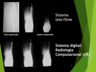 Sistema
tela-filme
Sistema digital:
Radiologia
Computacional (CR)
Sub-exposição Super-exposição
93
 