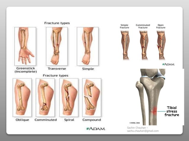 Fracture - Types, complications and management | PPTX