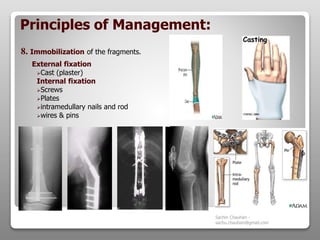 Fracture - Types, complications and management | PPTX