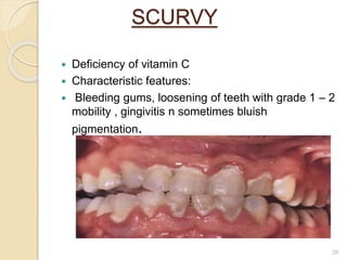 SCURVY
 Deficiency of vitamin C
 Characteristic features:
 Bleeding gums, loosening of teeth with grade 1 – 2
mobility , gingivitis n sometimes bluish
pigmentation.
26
 
