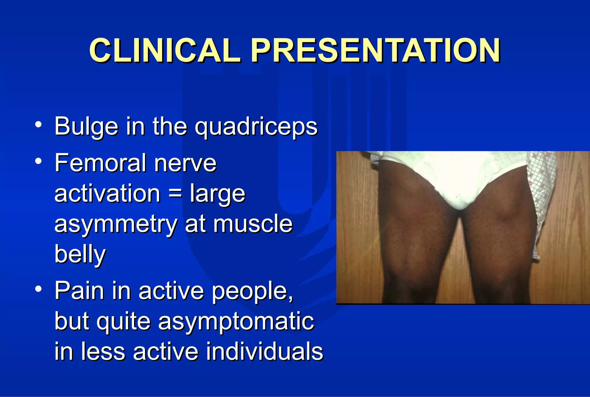 CLINICAL PRESENTATIONCLINICAL PRESENTATION
• Bulge in the quadricepsBulge in the quadriceps
• Femoral nerveFemoral nerve
activation = largeactivation = large
asymmetry at muscleasymmetry at muscle
bellybelly
• Pain in active people,Pain in active people,
but quite asymptomaticbut quite asymptomatic
in less active individualsin less active individuals
 