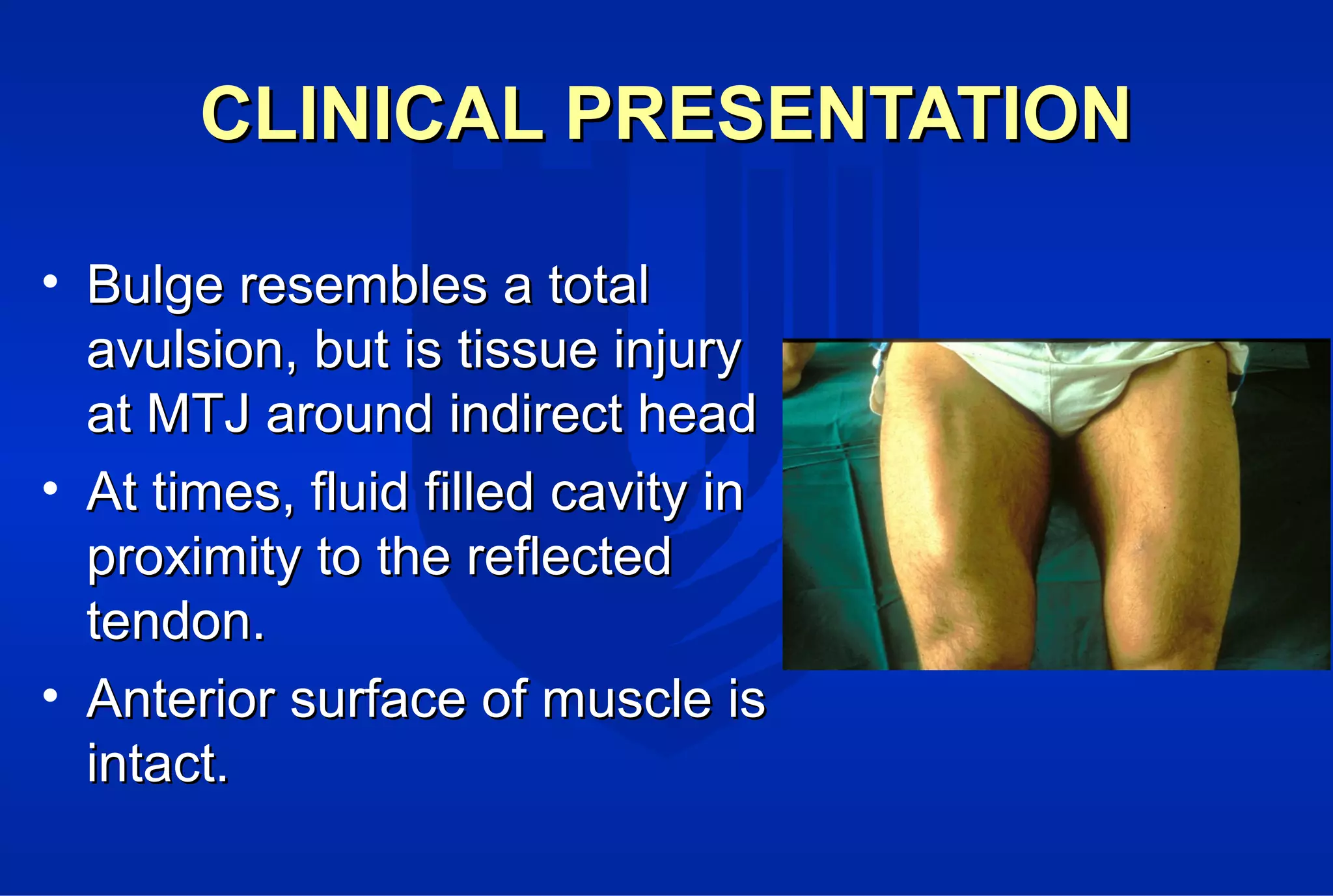 CLINICAL PRESENTATIONCLINICAL PRESENTATION
• Bulge resembles a totalBulge resembles a total
avulsion, but is tissue injuryavulsion, but is tissue injury
at MTJ around indirect headat MTJ around indirect head
• At times, fluid filled cavity inAt times, fluid filled cavity in
proximity to the reflectedproximity to the reflected
tendon.tendon.
• Anterior surface of muscle isAnterior surface of muscle is
intact.intact.
 