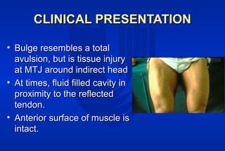 Rectus Femoris Injuries: what and when? William Garret | PPT