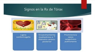Signos en la Rx de Tórax
 