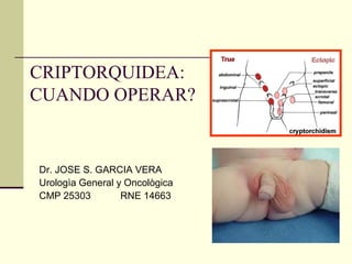 CRIPTORQUIDEA:
CUANDO OPERAR?
Dr. JOSE S. GARCIA VERA
Urologìa General y Oncològica
CMP 25303 RNE 14663
 