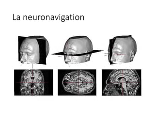 La	neuronavigation
 