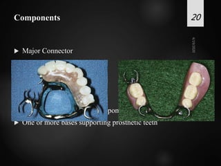  Major Connector
 Minor Connector
 Rests
 Direct retainers
 Indirect retainers
 Stabilizing or reciprocal components
 One or more bases supporting prosthetic teeth
Components 20
 