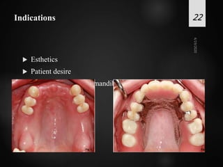 Indications
 Esthetics
 Patient desire
 Unfavorable Maxillomandibular relationships
22
 