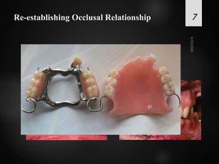 Re-establishing Occlusal Relationship
 Establish a new occlusal vertical dimension
 Condition teeth and ridge for optimum support
7
 