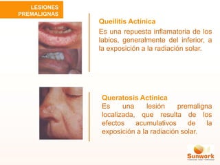 Queilitis Actínica
Es una repuesta inflamatoria de los
labios, generalmente del inferior, a
la exposición a la radiación solar.
Queratosis Actínica
Es una lesión premaligna
localizada, que resulta de los
efectos acumulativos de la
exposición a la radiación solar.
LESIONES
PREMALIGNAS
 