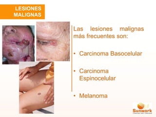 Las lesiones malignas
más frecuentes son:
• Carcinoma Basocelular
• Carcinoma
Espinocelular
• Melanoma
LESIONES
MALIGNAS
 