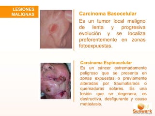 Carcinoma Basocelular
Es un tumor local maligno
de lenta y progresiva
evolución y se localiza
preferentemente en zonas
fotoexpuestas.
Carcinoma Espinocelular
Es un cáncer extremadamente
peligroso que se presenta en
zonas expuestas o previamente
alteradas por traumatismos o
quemaduras solares. Es una
lesión que se degenera, es
destructiva, desfigurante y causa
metástasis.
LESIONES
MALIGNAS
 
