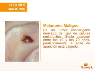 Melanoma Maligno
Es un tumor cancerígeno
derivado del tipo de células
melanocitos. Suele aparecer
entre los 40 y los 70 años,
paulatinamente la edad de
aparición está bajando.
LESIONES
MALIGNAS
 