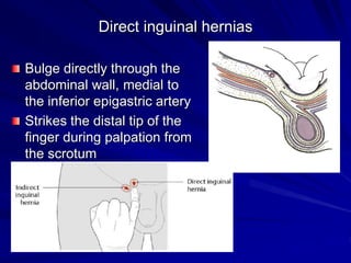 Direct inguinal hernias
Bulge directly through the
abdominal wall, medial to
the inferior epigastric artery
Strikes the distal tip of the
finger during palpation from
the scrotum
 