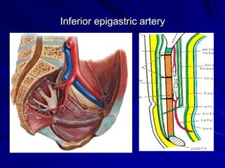 Inferior epigastric artery
 