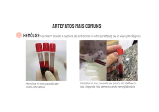 ARTEFATOSMAIS COMUNS
HEMÓLISE: ocorrem devido a ruptura de eritrócitos in vitro (artefato) ou in vivo (patológico)
Hemólise in vitro causada por
coleta dificultosa
Hemólise in vivo causada por picada de abelha em
cão. Segunda foto demonstrando hemoglobinúria
 
