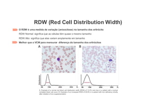 RDW (Red Cell Distribution Width)
O RDW é uma medida de variação (anisocitose) no tamanho dos eritrócito
RDW Normal: significa que as células têm quase o mesmo tamanho
RDW Alto: significa que elas variam amplamente em tamanho
Melhor que o VCM para mensurar diferença do tamanho dos eritrócitos
A: Example of a normal red blood cell distribution width (RDW) of 13.5% (red line) in a patient with a normal
complete blood cell count. B: Example of an increased RDW of 28.8% in a patient with iron deficiency shortly
after initiation of iron supplementation
 