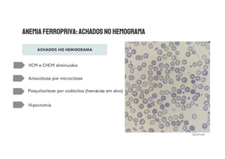 ACHADOS HO HEMOGRAMA
VCM e CHCM diminuídos
Anisocitose por microcitose
Poiquilocitose por codócitos (hemácias em alvo)
Hipocromia
Sanimvet
 