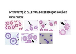 INTERPRETAÇÃO DALEITURA DO ESFREGAÇOSANGUÍNEO
 