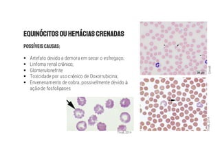 § Artefato devido a demora em secar o esfregaço;
§ Linfoma renal cr nico;
§ Glomerulonefrite
§ Toxicidade por uso cr nico de Doxorrubicina;
§ Envenenamento de cobra, possivelmente devido
ação de fosfolipases
Thrall, 2014
Thrall,
2014
Cornell
 