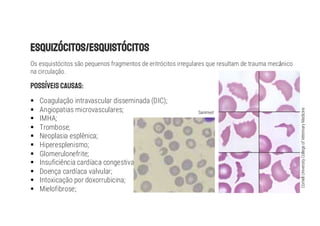 Os esquistócitos são pequenos fragmentos de eritrócitos irregulares que resultam de trauma mec nico
na circulação.
§ Coagulação intravascular disseminada (DIC);
§ Angiopatias microvasculares;
§ IMHA;
§ Trombose;
§ Neoplasia esplênica;
§ Hiperesplenismo;
§ Glomerulonefrite;
§ Insuficiência cardíaca congestiva;
§ Doença cardíaca valvular;
§ Intoxicação por doxorrubicina;
§ Mielofibrose;
Cornell
University
College
of
Veterinary
Medicine
Sanimvet
 