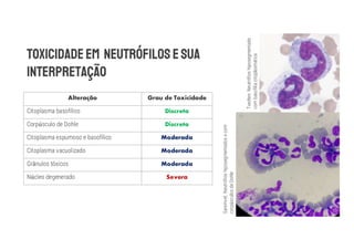 Alteração Grau de Toxicidade
Citoplasma basofílico Discreta
Corpúsculo de Dohle Discreta
Citoplasma espumoso e basofílico Moderada
Citoplasma vacuolizado Moderada
Grânulos tóxicos Moderada
Núcleo degenerado Severa
Sanimvet.
Neutrófios
hiposegmentados
e
com
corpúsculos
de
Dohle
Tvedten.
Neutrófios
hiposegmentado
com
basofilia
citoplasmática
 