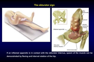 01.Acute appendicitis and chronic appendicitis.pdf