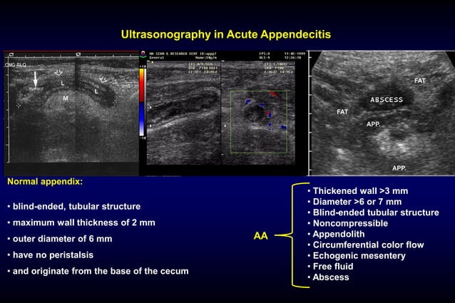 01.Acute appendicitis and chronic appendicitis.pdf