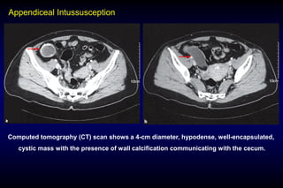 01.Acute appendicitis and chronic appendicitis.pdf
