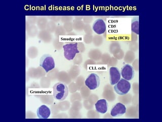 Smudge cell Granulocyte CLL cells CD19 CD5 CD23 Clonal disease of B lymphocytes smIg (BCR) 