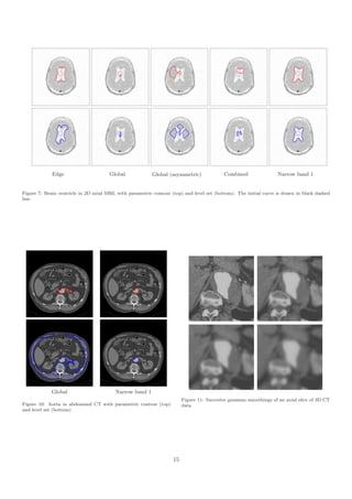 Edge                      Global             Global (asymmetric)               Combined                Narrow band 1


Figure 7: Brain ventricle in 2D axial MRI, with parametric contour (top) and level set (bottom). The initial curve is drawn in black dashed
line




             Global                       Narrow band 1
                                                                         Figure 11: Succesive gaussian smoothings of an axial slice of 3D CT
Figure 10: Aorta in abdominal CT with parametric contour (top)           data
and level set (bottom)




                                                                    15
 