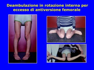 Deambulazione in rotazione interna per
eccesso di antiversione femorale
 