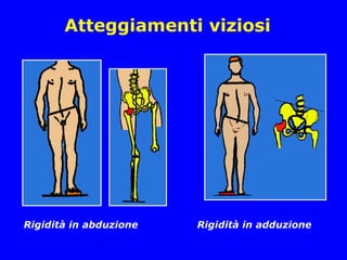 Atteggiamenti viziosi
Rigidità in abduzione Rigidità in adduzione
 