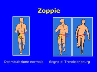 Zoppie
Deambulazione normale Segno di Trendelenbourg
 