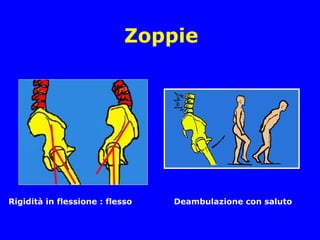 Zoppie
Rigidità in flessione : flesso Deambulazione con saluto
 