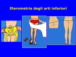 Eterometria degli arti inferiori
 