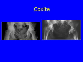 Coxite
 