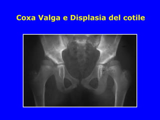 Coxa Valga e Displasia del cotile
 