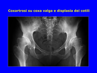 Coxartrosi su coxa valga e displasia dei cotili
 