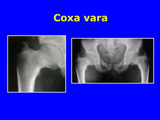 Coxa vara
 