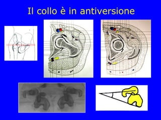 Il collo è in antiversione
 